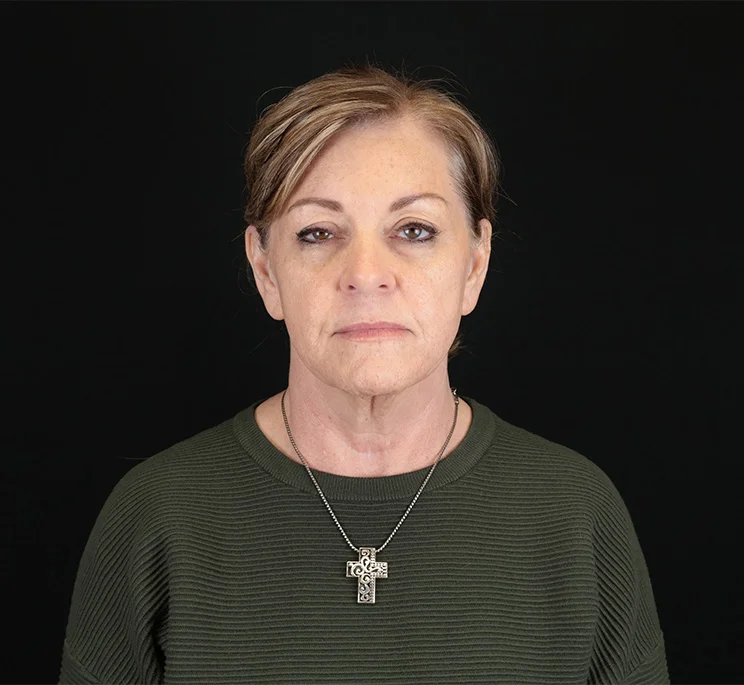 Real patient results in New York, NY Performed by Sameer Halani, MD