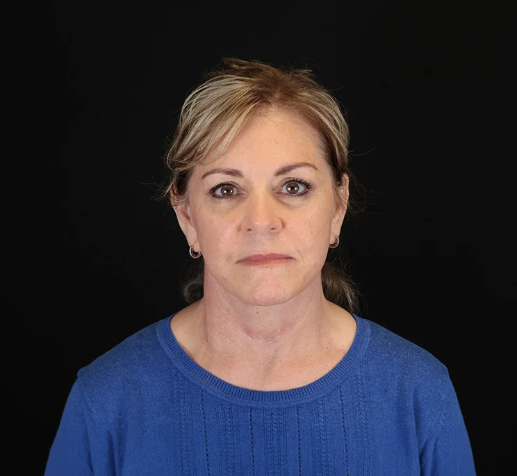 Real patient results in New York, NY Performed by Sameer Halani, MD