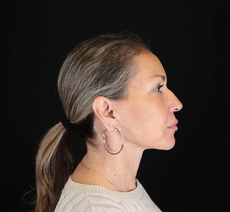 Real patient results in New York, NY Performed by Sameer Halani, MD