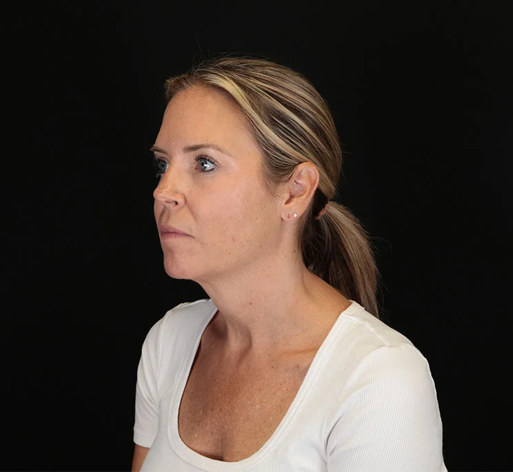 Real patient results in New York, NY Performed by Sameer Halani, MD