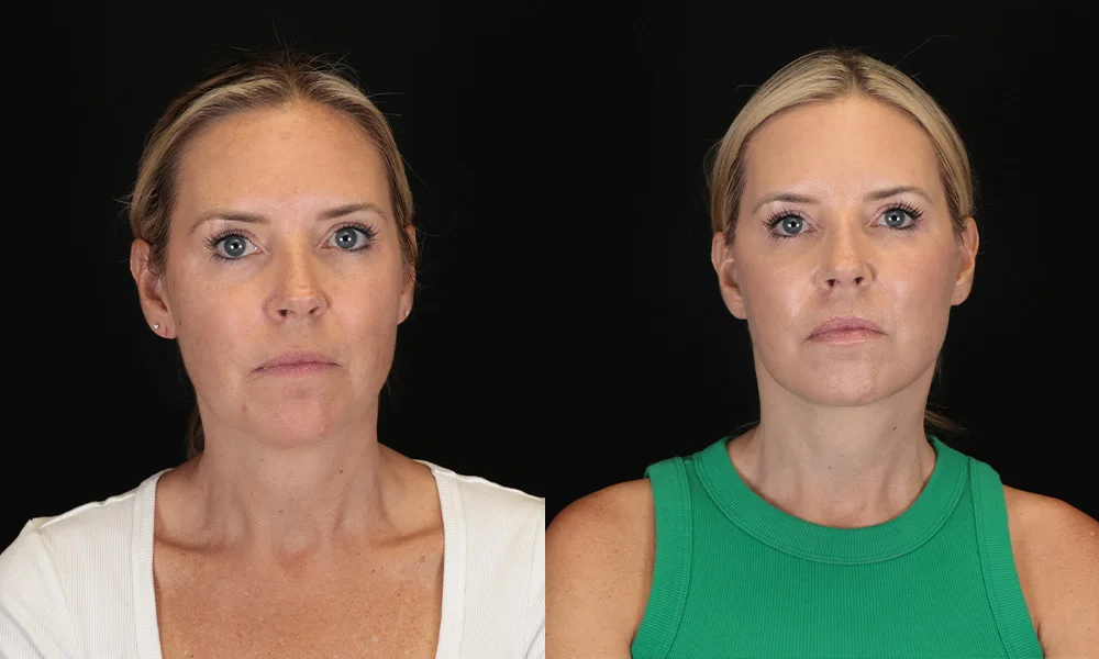 Real patient results in New York, NY Performed by Sameer Halani, MD