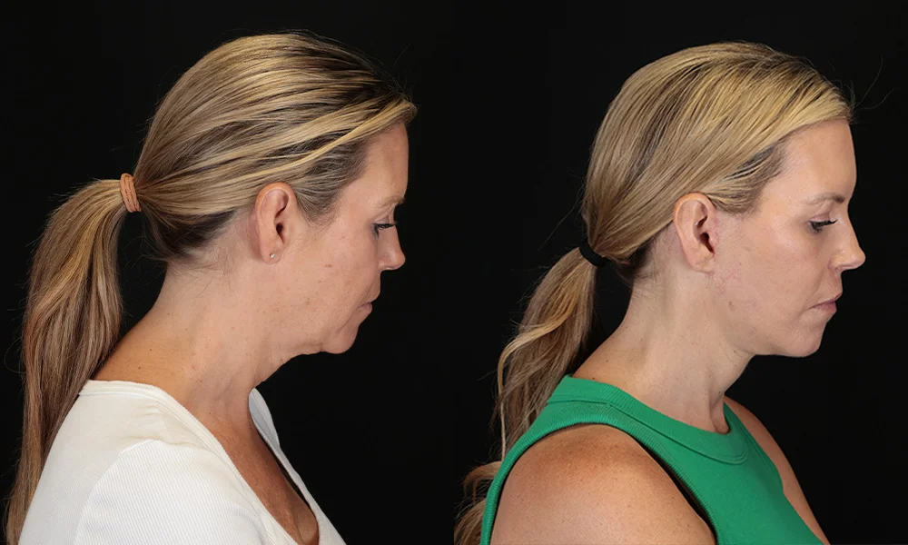 Real patient results in New York, NY Performed by Sameer Halani, MD