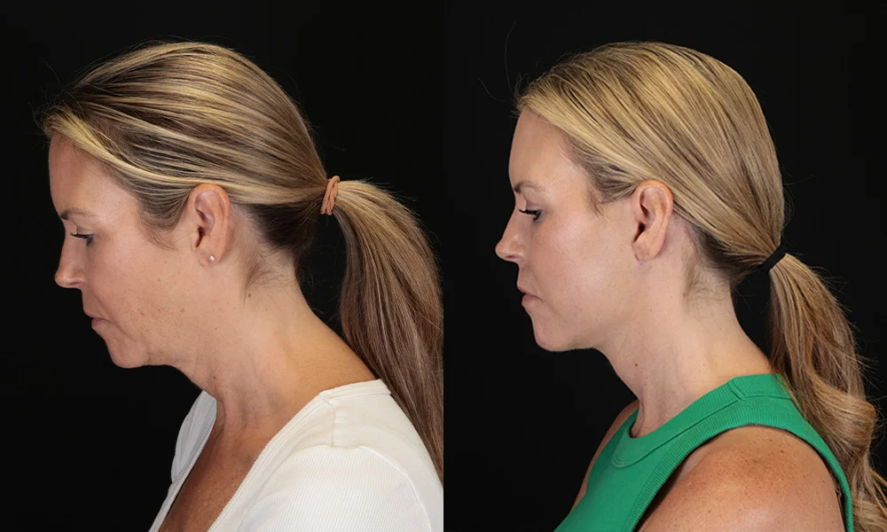 Real patient results in New York, NY Performed by Sameer Halani, MD