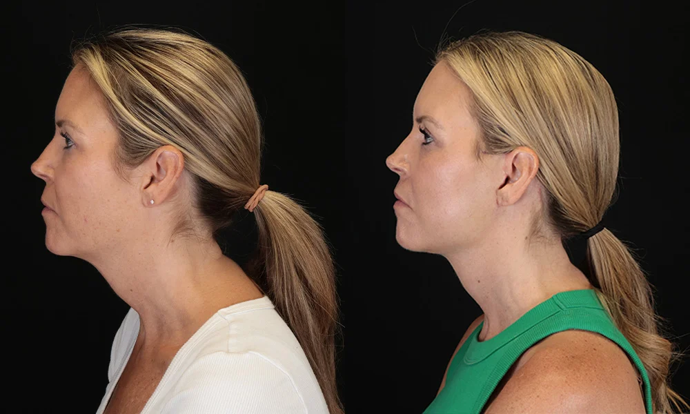 Real patient results in New York, NY Performed by Sameer Halani, MD