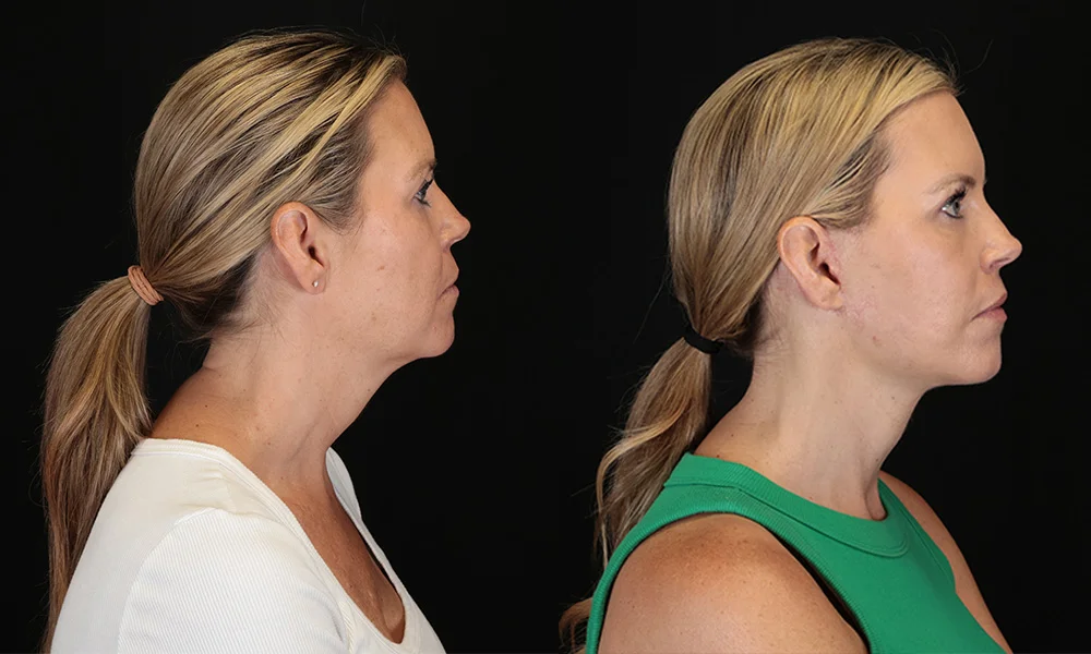 Real patient results in New York, NY Performed by Sameer Halani, MD