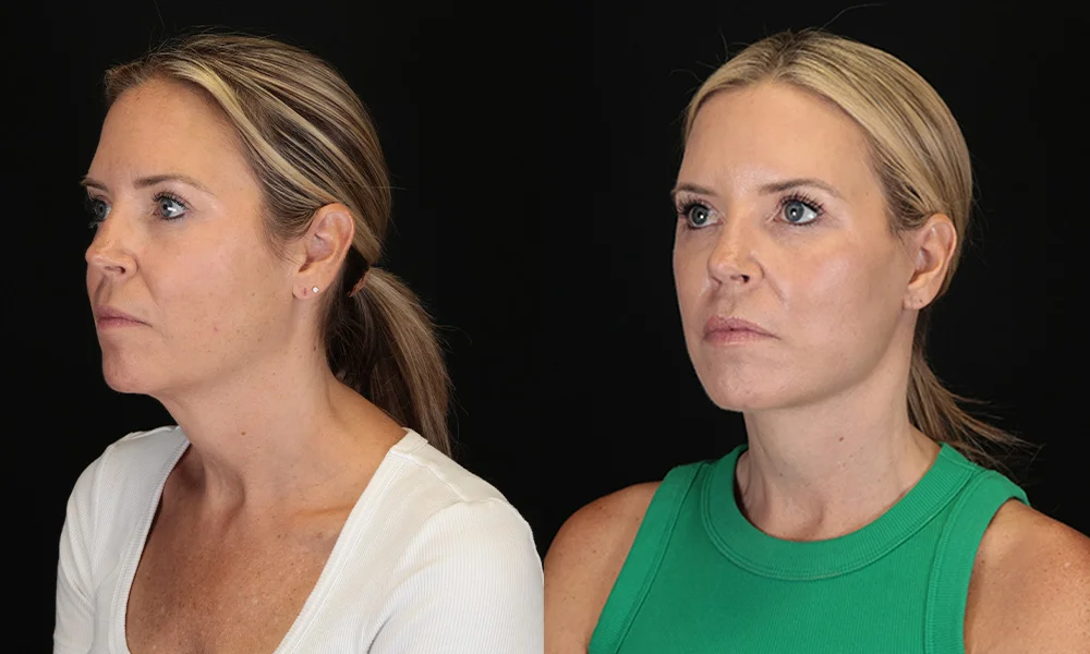Real patient results in New York, NY Performed by Sameer Halani, MD