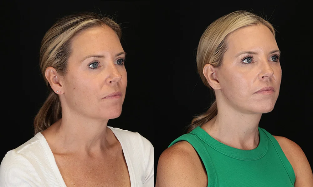 Real patient results in New York, NY Performed by Sameer Halani, MD