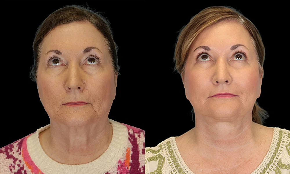 Real patient results in New York, NY Performed by Sameer Halani, MD