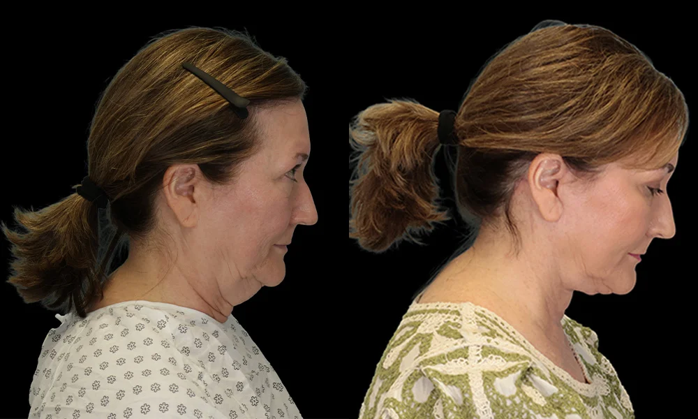 Real patient results in New York, NY Performed by Sameer Halani, MD