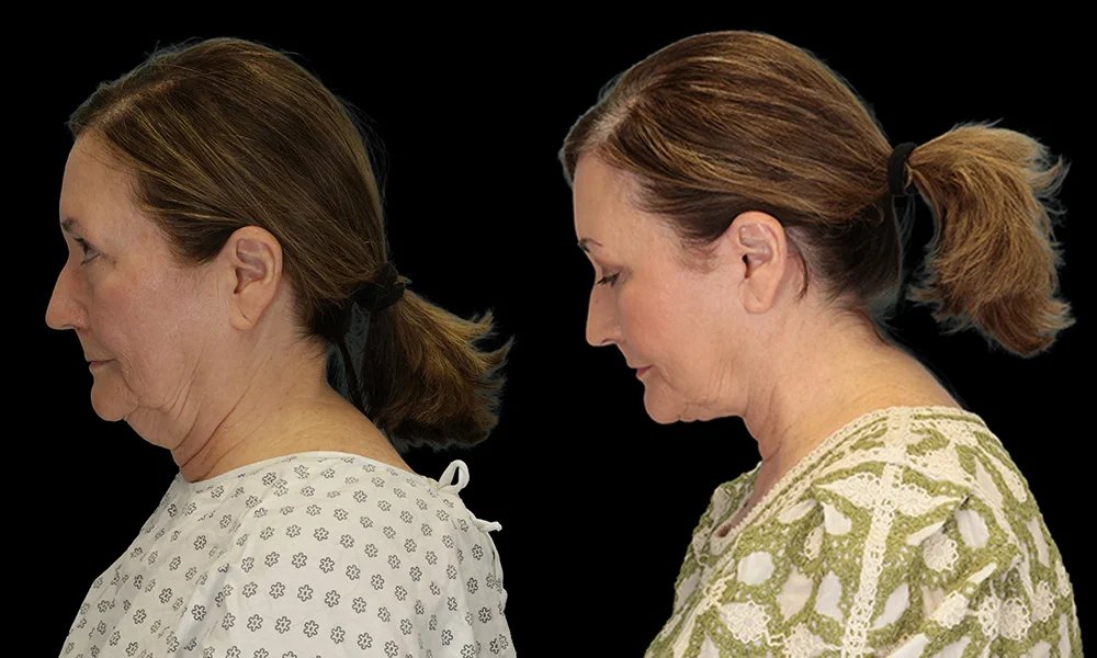 Real patient results in New York, NY Performed by Sameer Halani, MD