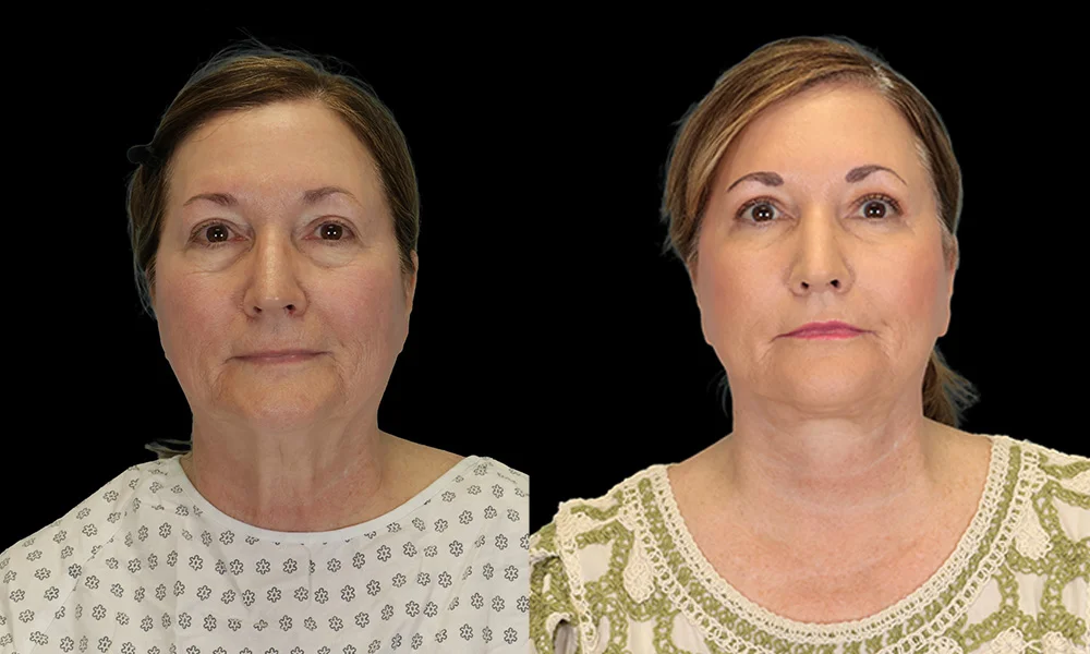 Real patient results in New York, NY Performed by Sameer Halani, MD