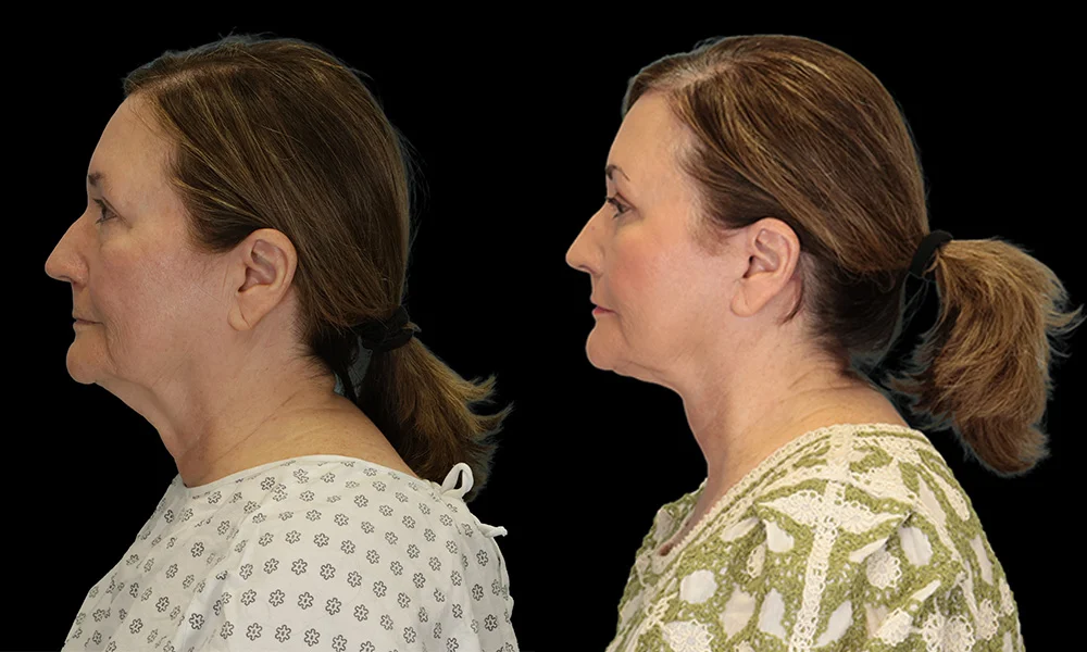 Real patient results in New York, NY Performed by Sameer Halani, MD