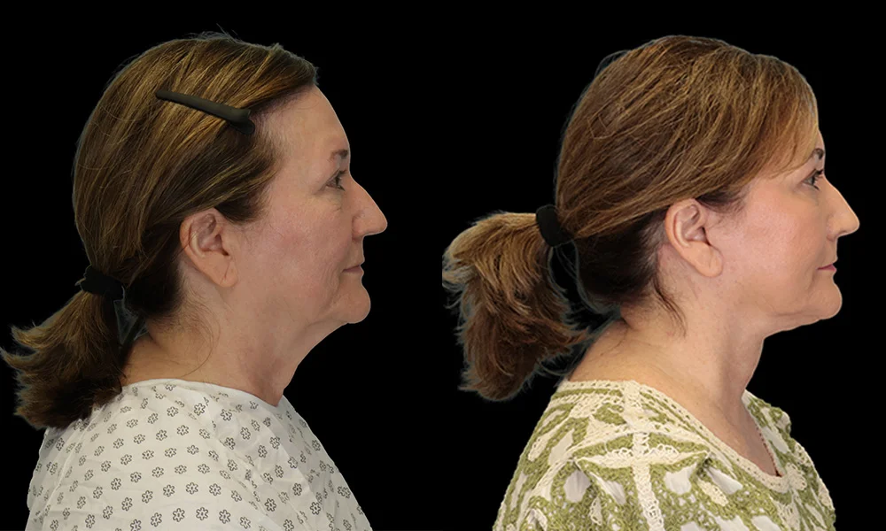 Real patient results in New York, NY Performed by Sameer Halani, MD