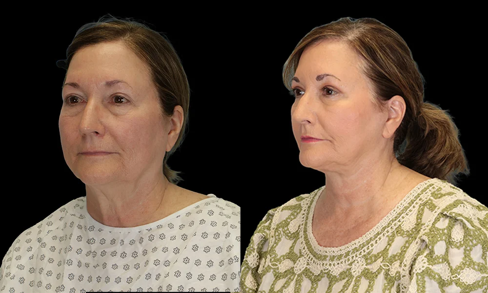 Real patient results in New York, NY Performed by Sameer Halani, MD