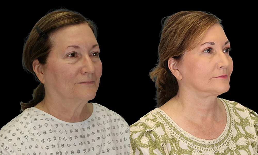 Real patient results in New York, NY Performed by Sameer Halani, MD