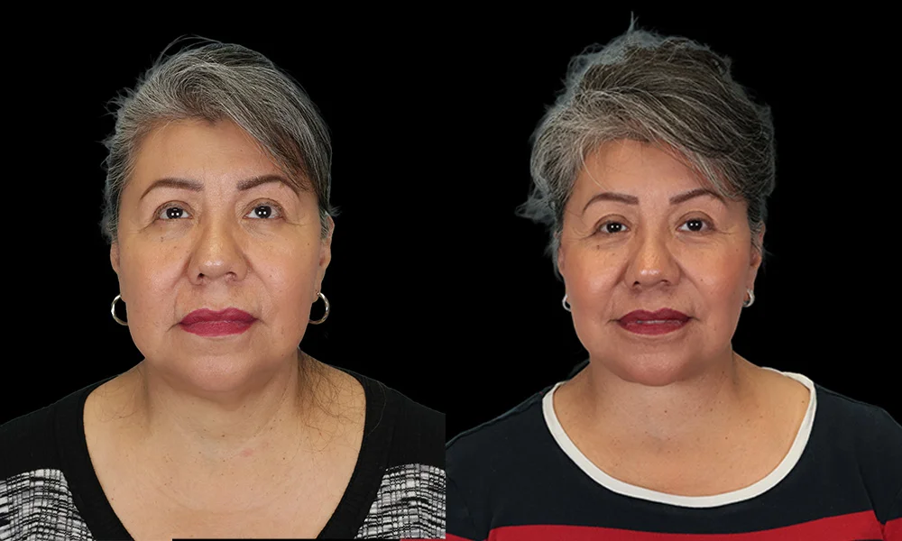 Real patient results in New York, NY Performed by Sameer Halani, MD