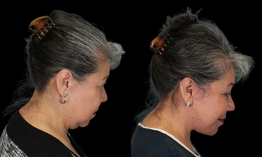 Real patient results in New York, NY Performed by Sameer Halani, MD