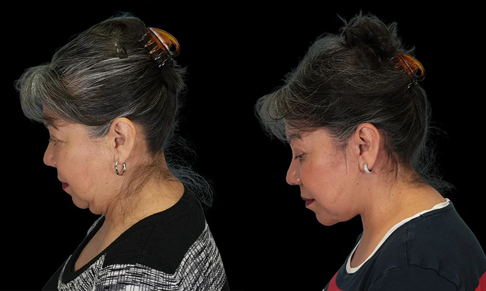 Real patient results in New York, NY Performed by Sameer Halani, MD