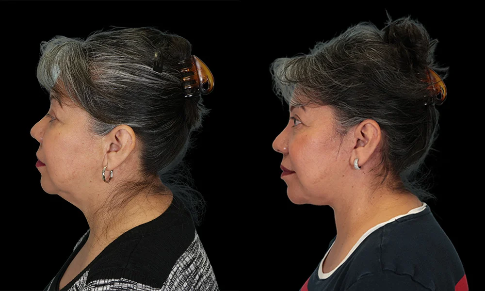 Real patient results in New York, NY Performed by Sameer Halani, MD