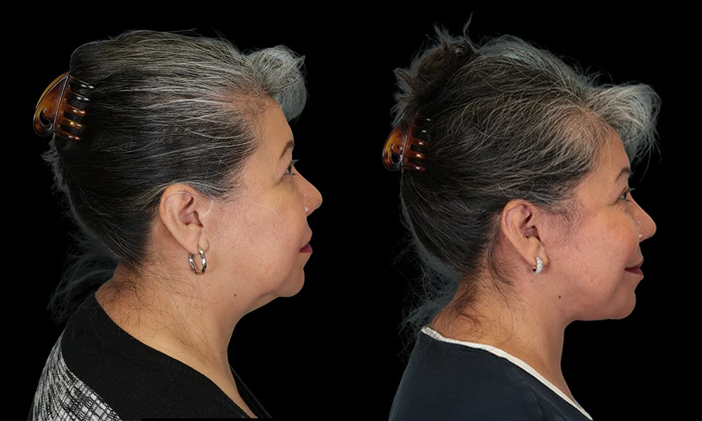 Real patient results in New York, NY Performed by Sameer Halani, MD