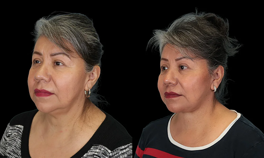 Real patient results in New York, NY Performed by Sameer Halani, MD