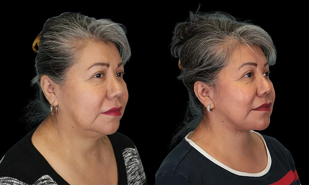 Real patient results in New York, NY Performed by Sameer Halani, MD
