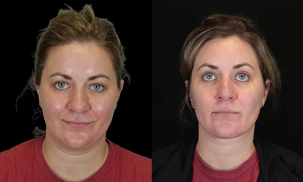 Real patient results in New York, NY Performed by Sameer Halani, MD