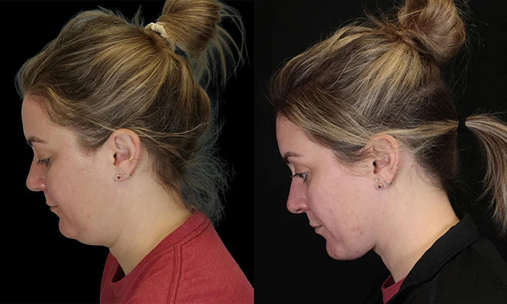 Real patient results in New York, NY Performed by Sameer Halani, MD