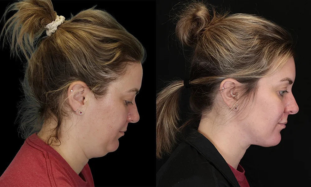 Real patient results in New York, NY Performed by Sameer Halani, MD