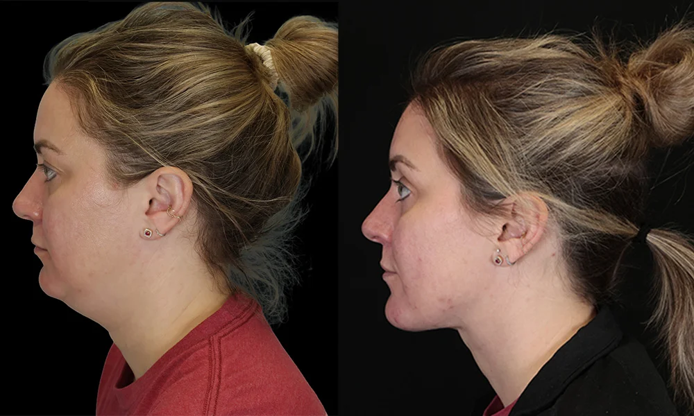 Real patient results in New York, NY Performed by Sameer Halani, MD