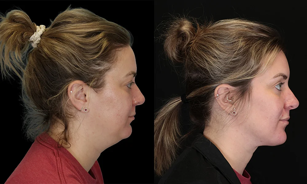 Real patient results in New York, NY Performed by Sameer Halani, MD
