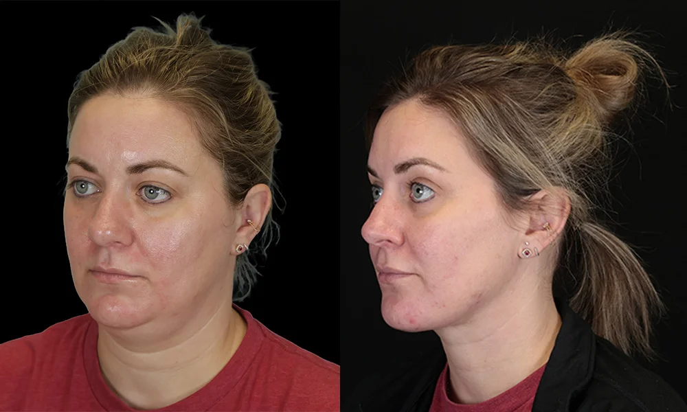 Real patient results in New York, NY Performed by Sameer Halani, MD
