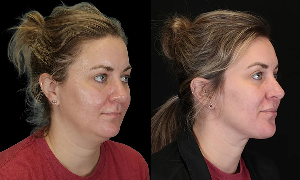 Real patient results in New York, NY Performed by Sameer Halani, MD