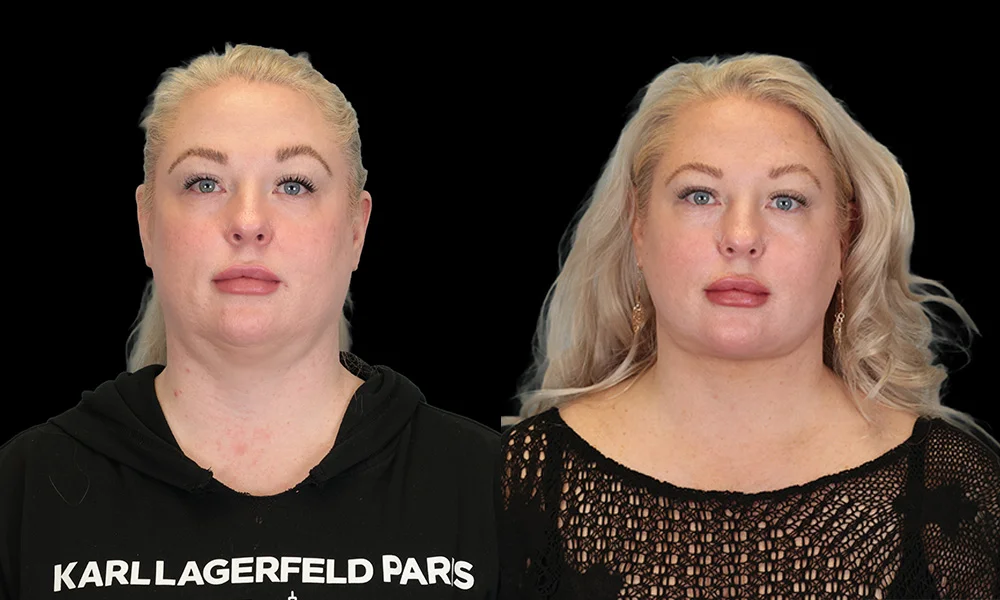 Real patient results in New York, NY Performed by Sameer Halani, MD