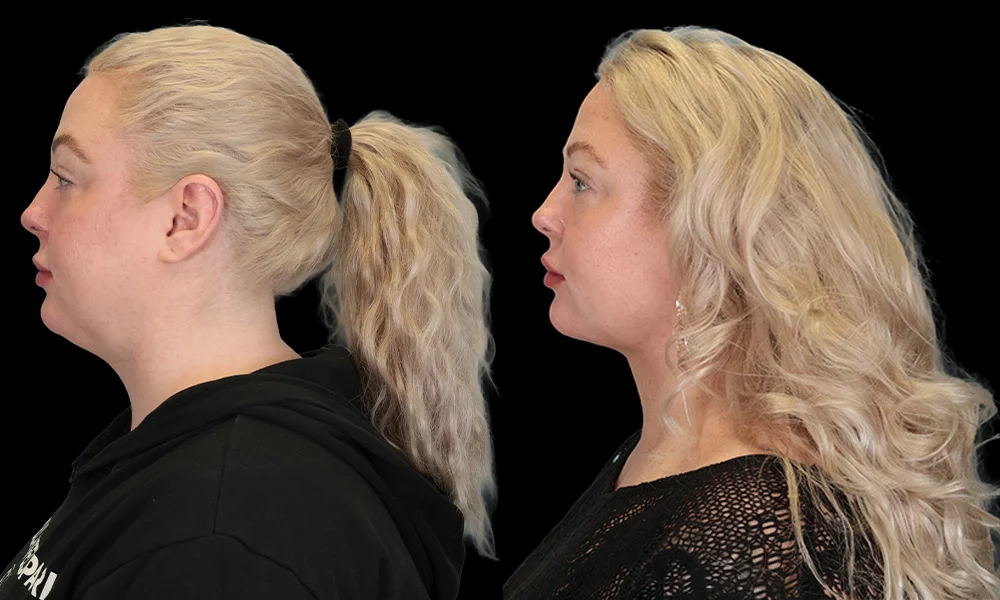 Real patient results in New York, NY Performed by Sameer Halani, MD