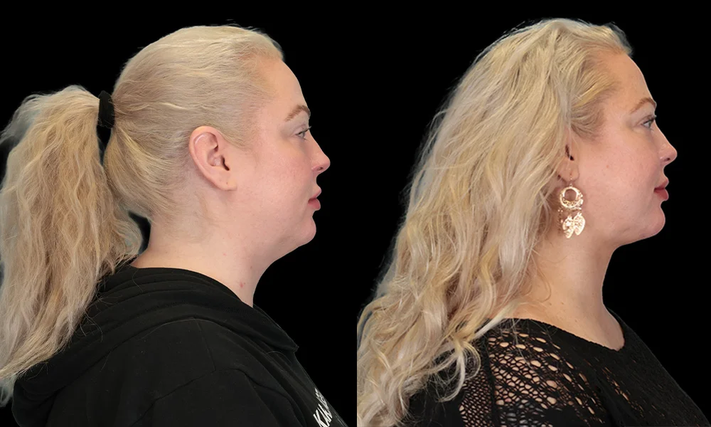Real patient results in New York, NY Performed by Sameer Halani, MD