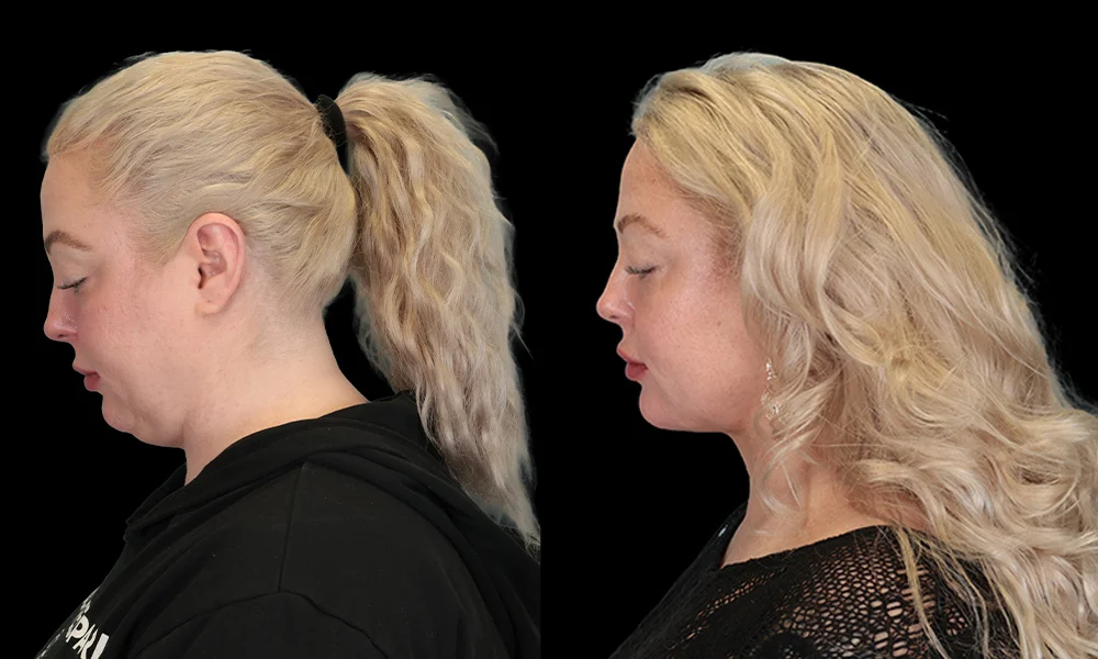 Real patient results in New York, NY Performed by Sameer Halani, MD