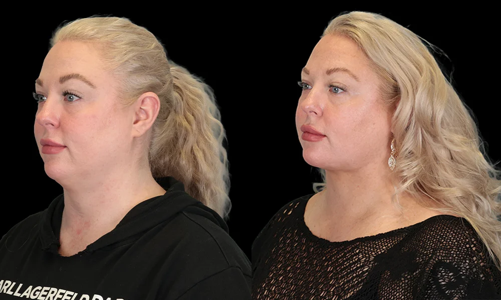 Real patient results in New York, NY Performed by Sameer Halani, MD