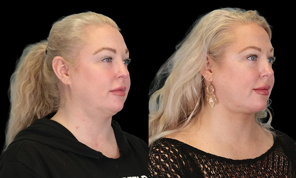 Real patient results in New York, NY Performed by Sameer Halani, MD
