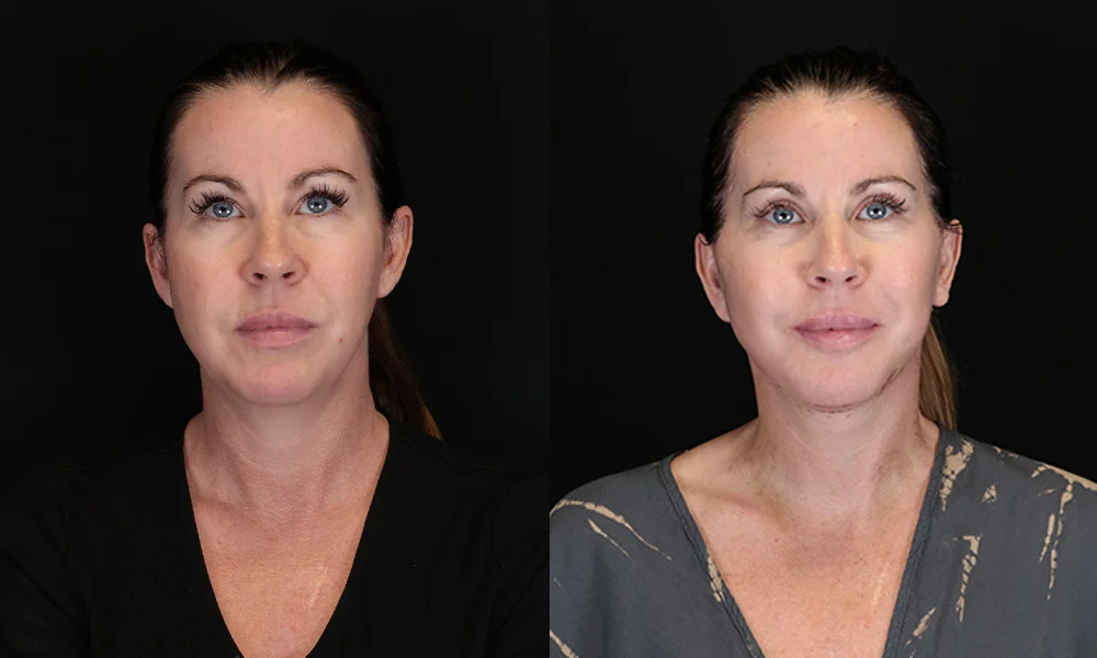 Real patient results in New York, NY Performed by Sameer Halani, MD