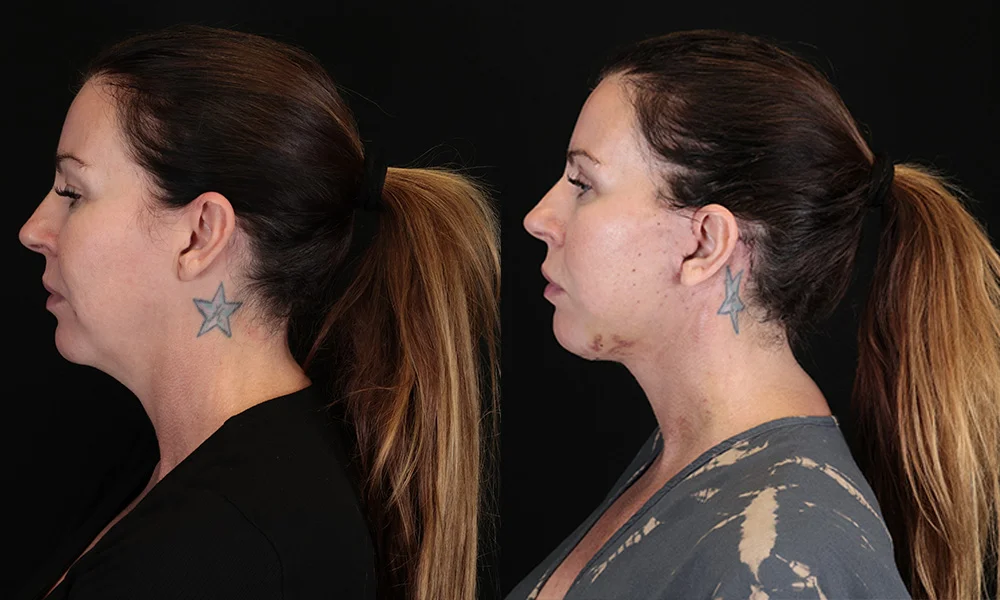 Real patient results in New York, NY Performed by Sameer Halani, MD