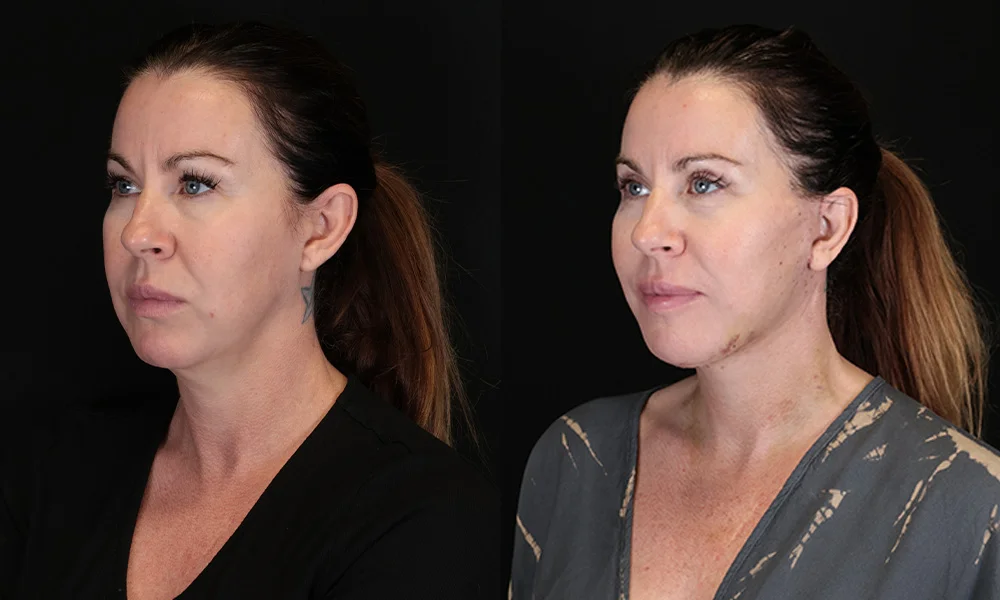 Real patient results in New York, NY Performed by Sameer Halani, MD