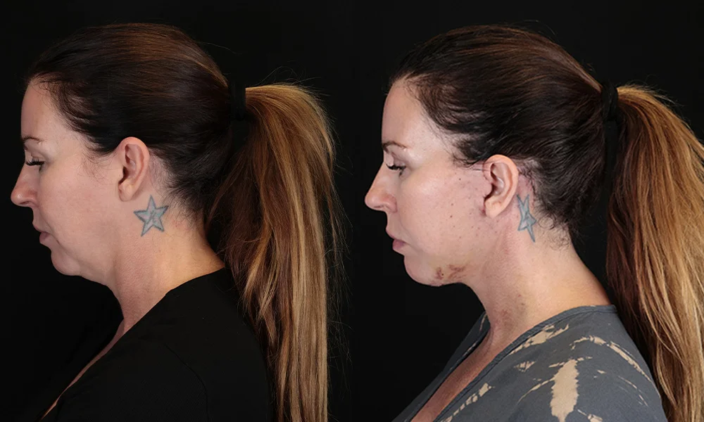 Real patient results in New York, NY Performed by Sameer Halani, MD