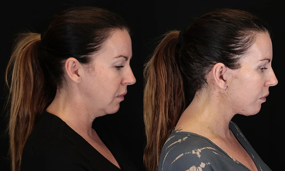 Real patient results in New York, NY Performed by Sameer Halani, MD