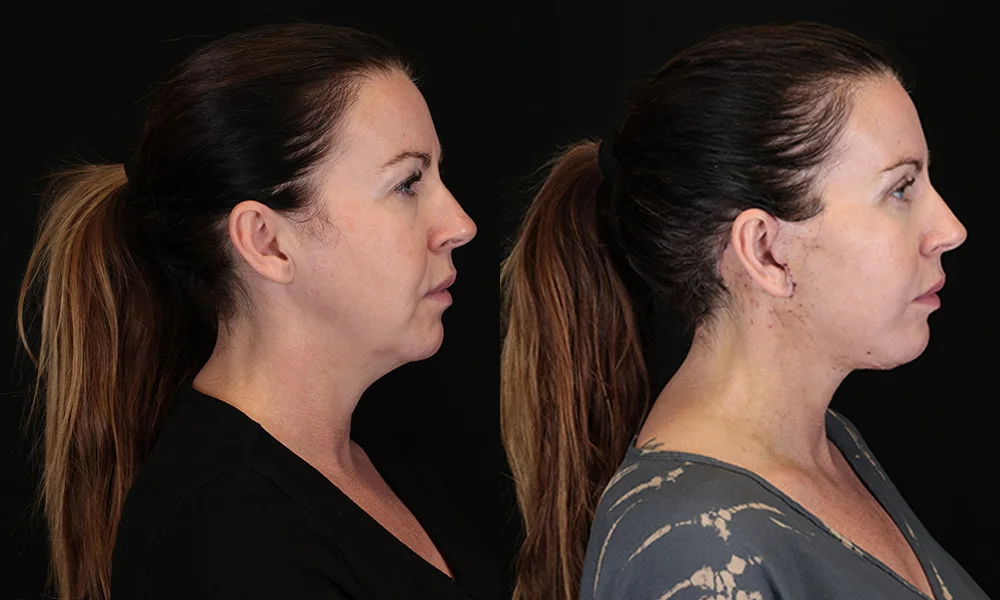 Real patient results in New York, NY Performed by Sameer Halani, MD