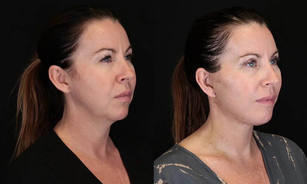Real patient results in New York, NY Performed by Sameer Halani, MD
