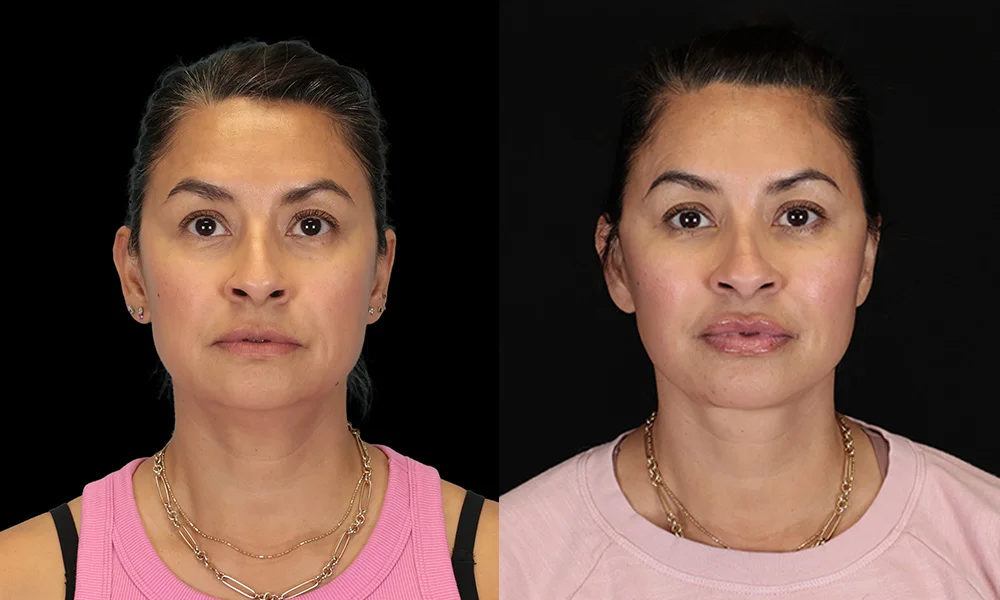 Real patient results in New York, NY Performed by Sameer Halani, MD