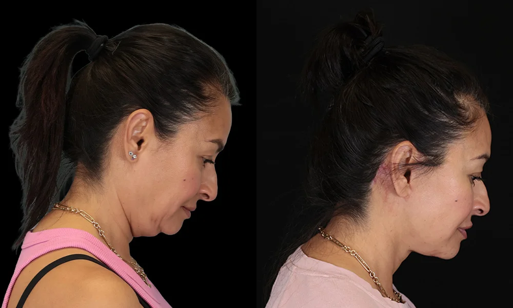 Real patient results in New York, NY Performed by Sameer Halani, MD