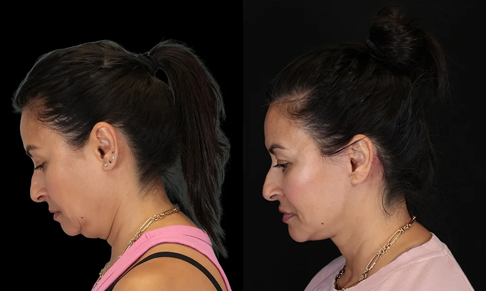 Real patient results in New York, NY Performed by Sameer Halani, MD