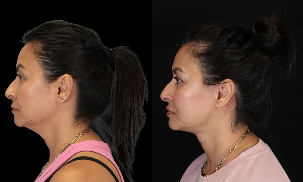 Real patient results in New York, NY Performed by Sameer Halani, MD